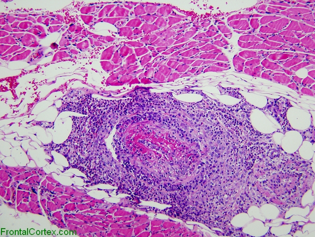 Churg strauss arteritis involving skeletal muscle, H&E stain x 100